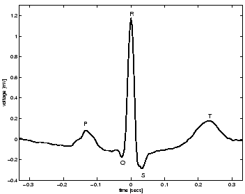 \begin{figure}
\centerline{\psfig{file=garipqrst.eps,width=7.75cm}}
\end{figure}